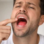 Why Does the Roof of My Mouth Hurt with common causes of palate pain and relief tips